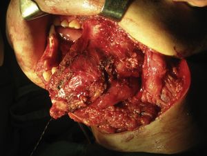 Resección quirúrgica de ameloblastoma mandibular.