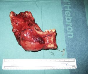 Pieza quirúrgica de resección del ameloblastoma.