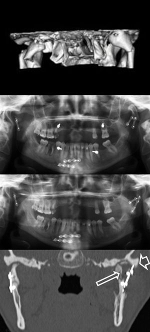 Fractura bicondílea y parasinfisaria. Se observa en la imagen 3D la luxación completa a medial del cuello y la cabeza del cóndilo izquierdo. Tras la primera cirugía, la OPG de control mostró la cabeza del cóndilo fuera de la fosa glenoidea. En la segunda cirugía se consiguió una adecuada reducción y alineamiento, objetivada en una nueva OPG. La TC (corte coronal) demuestra la afectación de la medular de la cabeza del cóndilo (flecha larga), a consecuencia de una infección posquirúrgica y el material de osteosíntesis impactado en el borde externo de la fosa glenoidea (flecha corta). En el momento de la redacción de este manuscrito, la paciente estaba pendiente de la retirada de la placa.