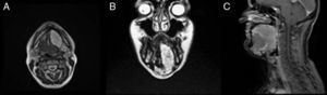 Imágenes de la resonancia magnética, donde se aprecia el tamaño y extensión de la tumoración. A: Corte axial. B: Corte coronal. C: Corte sagital.