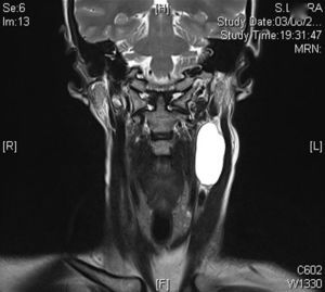 Corte coronal de RNM identificando quiste medial a ECM, hiperintenso en secuencia T2.