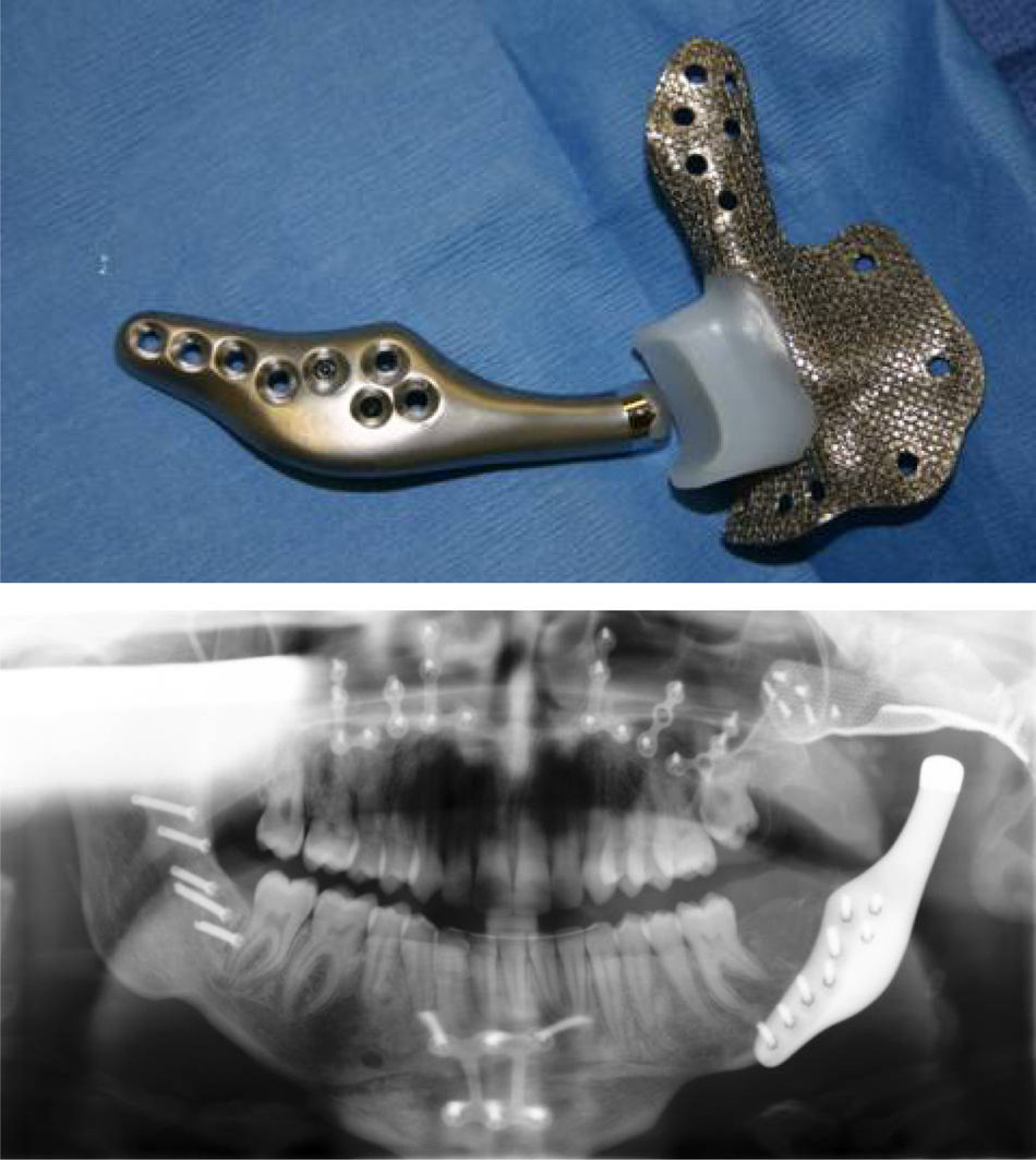 The role of custom-made prosthesis for temporomandibular joint ...