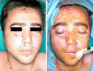 Paciente número 1. A: Imagen preoperatoria de múltiples carcinomas basocelulares en cara y cuello. B: Detalle postoperatorio inmediato tras la exéresis.