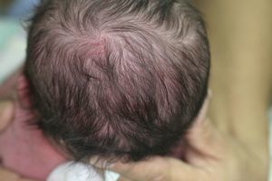 En la imagen se aprecia la alopecia del vertex, signo clínico más común de la incontinencia pigmentaria.