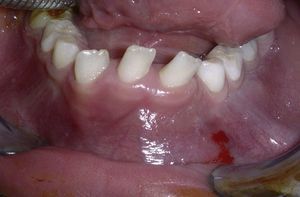 Imagen preoperatoria que muestra el abombamiento de la cortical vestibular mandibular, con mucosa oral normal.