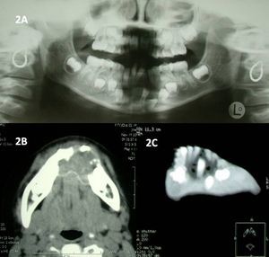 OPG inicial que muestra una imagen radiolúcida de márgenes mal definidos de 73 a 83, con basilar desestructurada y 3 piezas dentales definitivas incluidas en la lesión. Figura 2B Corte axial de TC en el que se observa una tumoración osteolítica, insuflante y multilocular que afecta a todo el espesor de la sínfisis mandibular, pero mantiene las corticales íntegras. Figura 2C TC con reconstrucción 3D que revela una lesión quística en sínfisis mandibular con piezas incluidas en su interior.