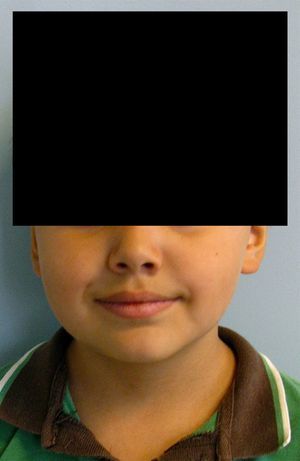 Fotografía extraoral del paciente en la cual puede observarse una leve asimetría facial debido a un aumento de volumen mandibular derecho.