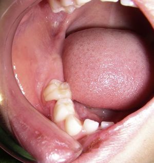 Fotografía intraoral del lado derecho en la cual se aprecia un aumento de volumen vestibular que compromete gran parte de la mandíbula. La mucosa se encuentra indemne.