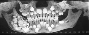 Cone Beam panorámico. Se observa extensa lesión radiolúcida unilocular de límites netos con contenido variable de estructuras radiopacas similares a estructuras dentarias que compromete cuerpo y rama mandibular derechos.