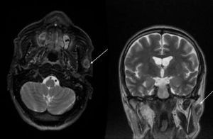 Se solicitó RM de cabeza y cuello donde se delimitó la tumoración (marcado con flecha), compatible con adenopatía. Cortes coronal (izquierda) y axial (derecha).