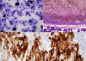 Citología en la que se aprecian células tumorales y restos de pigmento en la imagen superior izquierda, corte histológico de la biopsia de una adenopatía (superior derecha) e inmunohistoquímica positiva para MelanA (inferior).