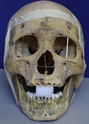 Vista frontal del cráneo y la mandíbula humanos secos, para mostrar la ubicación de los alambres de acero en cada uno de los 15 cuadrantes. Se aprecia claramente la posición horizontal y vertical de los alambres.