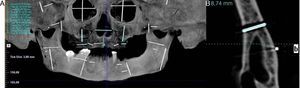 A, B. Imágenes tomográficas de cono vistas en pantalla de Planeación de Implantes; A) en Vista de Mapa Panorámico y B) en Vista de Corte Transversal. Se pueden observar las imágenes de los alambres colocados en los 3 planos espaciales en los diferentes cuadrantes en que fueron divididos el cráneo y la mandíbula. En la parte superior izquierda aparecen las medidas tomadas a las imágenes de estos alambres.