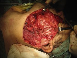Lecho quirúrgico tras extirpación de la pieza en el que se evidencian las ramas disecadas del tronco del nervio facial.