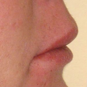 Complicación inmediata. Edema postinfiltración con ácido hialurónico.