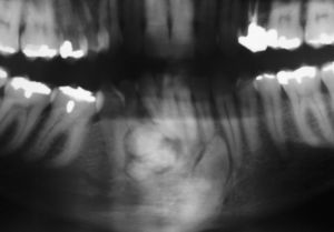 Radiografía panorámica evidenciando el aspecto radiopaco de la lesión y del diente 43 no-erupcionado.