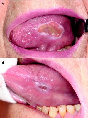 Imágenes clínicas de la evolución de la lesión ulcerosa lingual, al mes y medio (A) y al quinto mes de evolución (B).