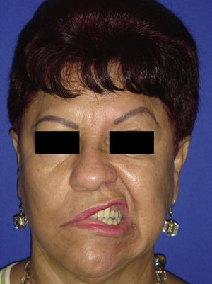 Parálisis de la mitad facial derecha comprometiendo los músculos de la expresión facial del recorrido del vii par craneal o nervio facial.
