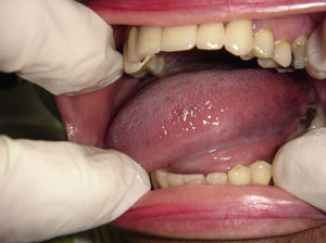 Lesión de tipo ulcerativa, redondeada de 5mm de diámetro localizada en el lado izquierdo de la lengua.