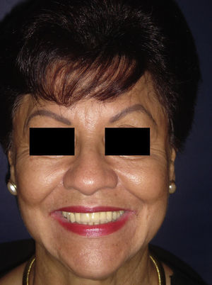 Recuperación completa de la función del nervio facial a los 30 días.