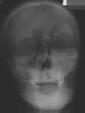En la telerradiografía posteroanterior de control septiembre 2011, se observa el proceso osteolítico disminuido en extensión como en radio opacida respecto a radiografía inicial en zona maxilar izquierda.