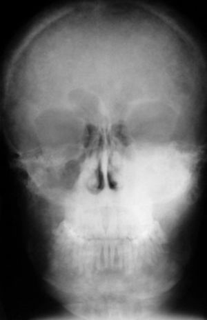 En la telerradiografía posteroanterior se observa un proceso osteolítico que afectan el maxilar izquierdo (ocupando el seno maxilar) y la mandíbula.