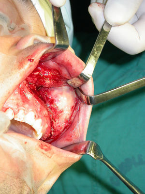 Intraoperatorio donde se observa acceso y exposición parcial del tumor.