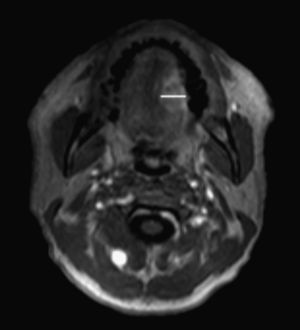 Paciente con carcinoma en el borde lateral izquierdo lingual. Plano axial en secuencia T1 poscontraste.
