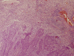 Imagen histológica donde se observa el borde tumoral correspondiente con la profundidad de invasión.