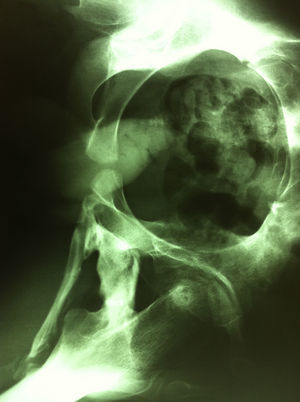 Radiografía de pelvis donde se observan fenómenos de calcificación múculo-tendinosa.