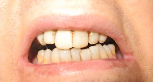 Paciente con trismus intenso y limitación de la apertura oral restringida a 1mm.