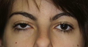 Mujer de 17 años con distopia ocular. Se observa desplazamiento craneal del globo ocular derecho con respecto al izquierdo.