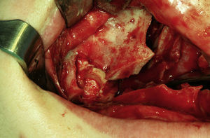 Imagen intraoperatoria donde se observa la tumoración ósea en la cavidad sinusal tras el descenso del maxilar.