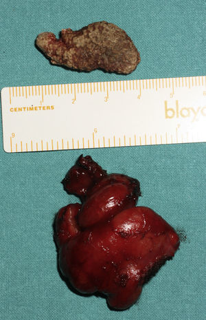 Litiasis y glándula submaxilar derecha.