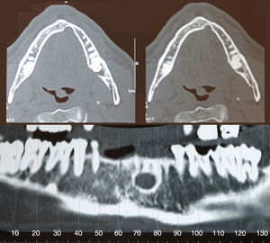 Tomografía computarizada, cortes axiales y coronal: lesión lítica en la cortical lingual mandibular de la región parasinfisaria izquierda, sin afectación de la cortical vestibular.