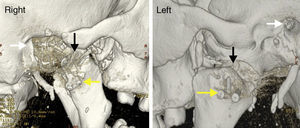 This illustration shows the TMJ reconstruction. Note the close relationship between the external auditory meatus and the TMJ and that the right side is more damaged than the left side. White arrow=external auditory meatus; black arrow=TMJ (prosthesis=acrylic ball has been placed in position); yellow arrow=titanium material. (For interpretation of the references to color in this figure legend, the reader is referred to the web version of the article.)