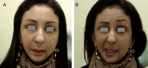 This illustration shows a patient with right facial palsy. Observe that when the patient moves her facial muscles (B), palsy and spasticity become evident.