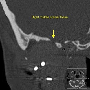 This illustration shows the proximity of the middle fossa with the middle ear (right side). Note the destruction in the region of the lateral skull base structures and the involvement of the middle fossa floor. Yellow arrow: Area of discontinuous bone of middle fossa floor. (For interpretation of the references to color in this figure legend, the reader is referred to the web version of the article.)