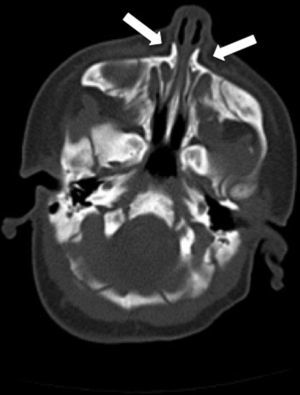TC axial sin contraste con un día de vida. Disminución del diámetro de la apertura piriforme (8mm). Se comprueba la permeabilidad coanal.