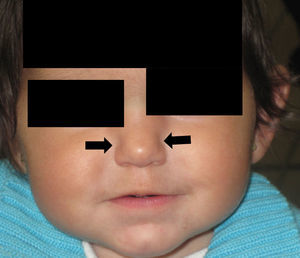 Estrechez de la región nasal correspondiente a la escotadura piriforme a los 11 meses de edad.