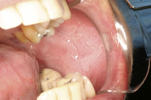 Imagen intraoral de la madre del paciente donde se aprecian las lesiones blanquecinas sobreelevadas con estriaciones en el borde lateral lingual y en la mucosa yugal izquierdos.