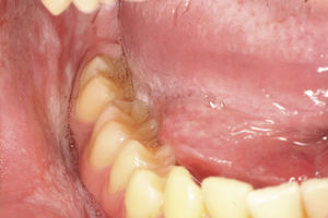 Imagen intraoral derecha donde se aprecia la lesión blanquecina y estriada de aspecto algodonoso en la mucosa yugal y en el borde lateral de la lengua.