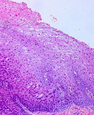 HE(× 200): se observa un marcado edema intracelular de las células epiteliales, sobre todo de las células más superficiales. Los núcleos aparecen condensados. No existen signos de displasia.