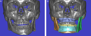 a) Imagen 3D del esqueleto craneofacial de un paciente con desviación de la línea media mentoniana hacia la izquierda y canting maxilar. b) Resultado tras la cirugía virtual, corrigiendo la asimetría facial el canting maxilar y la oclusión hasta la clase i tras planificar una cirugía bimaxilar con mentoplastia.