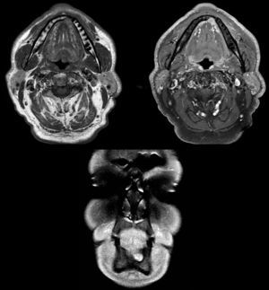Resonancia nuclear magnética, cortes axiales y coronal: señal hiperintensa erosionando la cortical lingual mandibular en la región parasinfisaria izquierda, en la localización de la glándula sublingual.