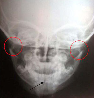 Preoperative posteroanterior radiograph of case 1 showing right parasymphysis fracture (black arrow with bilateral subcondylar fracture (red circles).
