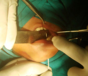 Intraoperative photograph showing IVCS inserted percutaneously and exited lingually.