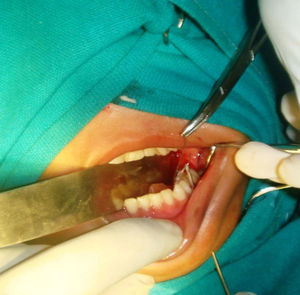 Intraoperative photograph showing IVCS exited buccally.