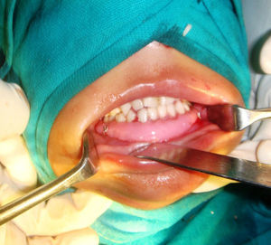 Intraoperative photograph showing splint in place.