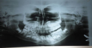 Preoperative panoramic radiograph showing parasymphysis fracture of case 2.